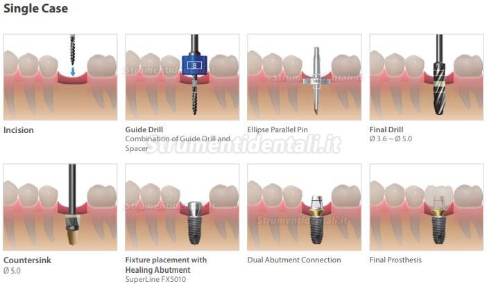 Kit guida impianto dentium (Kit ISGK) / Kit strumenti odontoiatrici